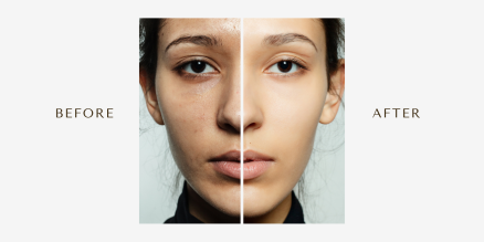 كيفية التخلص من فرط التصبغ والبقع الداكنة